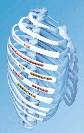 Imagen: El sistema MatrixRIB, hecho para ayudarles a los cirujanos a obtener acceso a las lesiones óseas (Fotografía cortesía de DePuy Synthes).